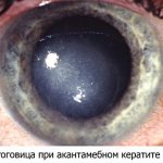 Corneal keratitis - symptoms (signs)